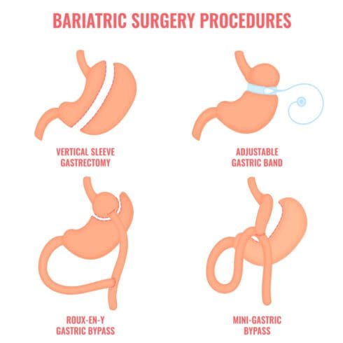 weight loss surgery cost procedures cost of weight loss surgery