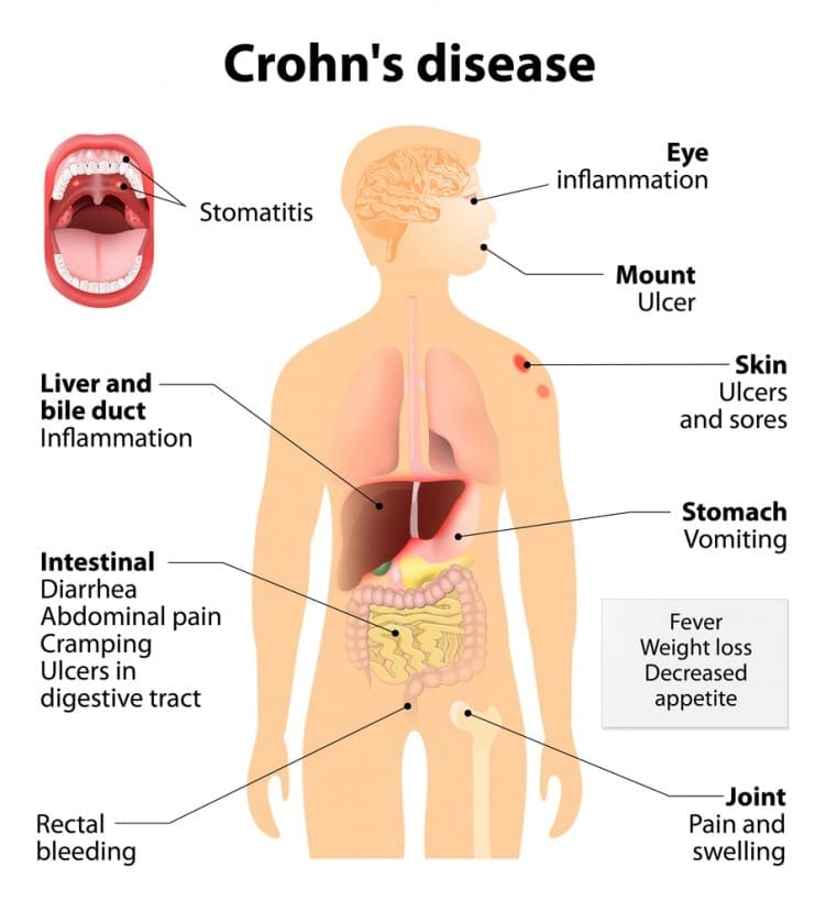 Crohn's disease diagram