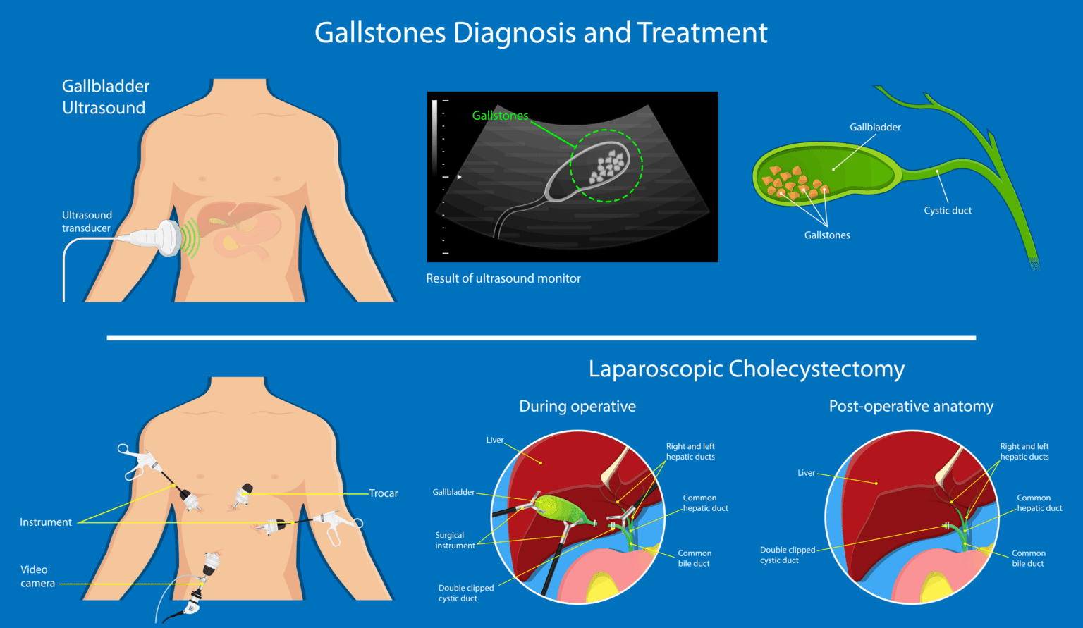 Cholecystectomy or Gallbladder Removal Cost to go Private The Best Of Health