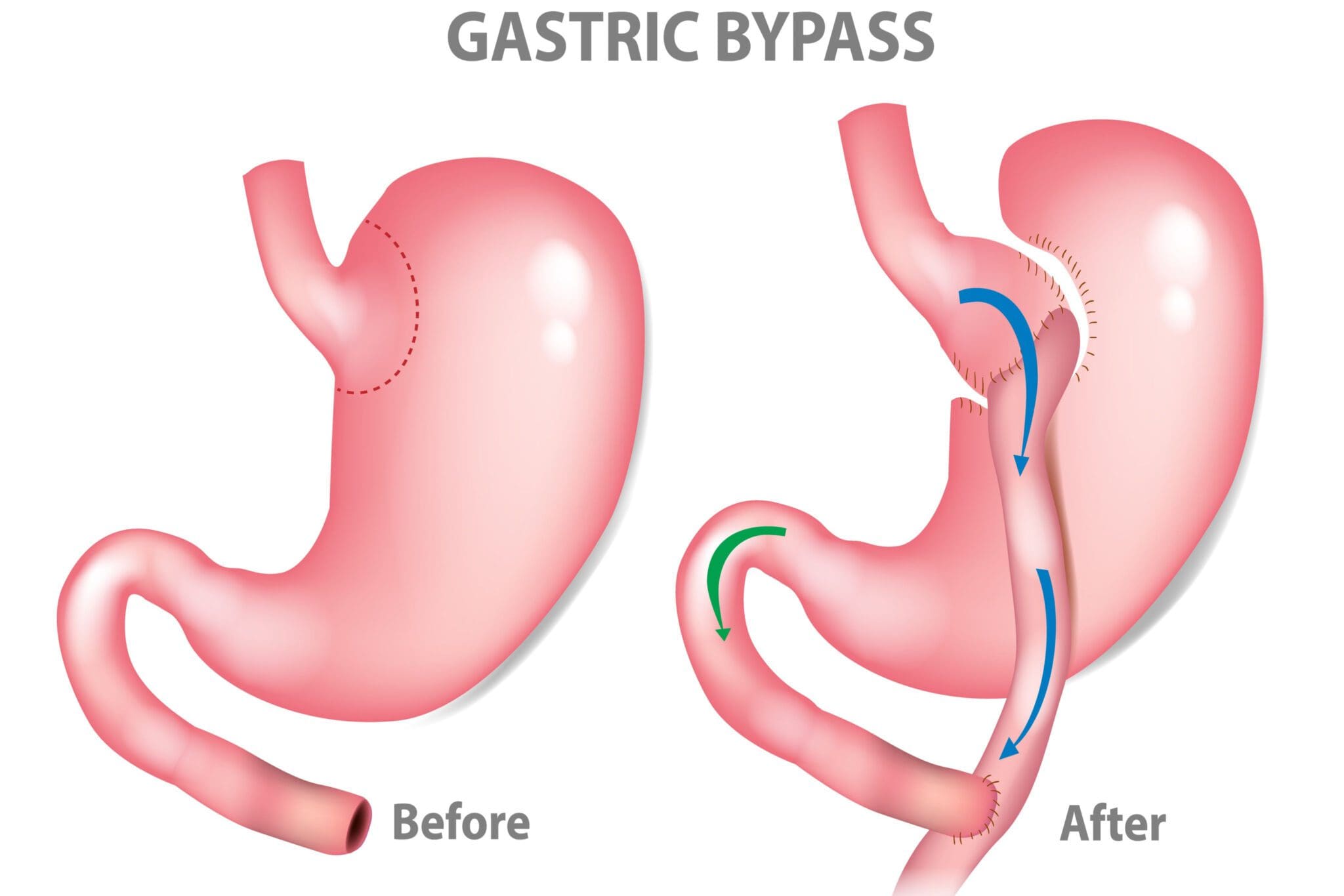 How Much Does Weight Loss Surgery Cost in the UK? The Best Of Health