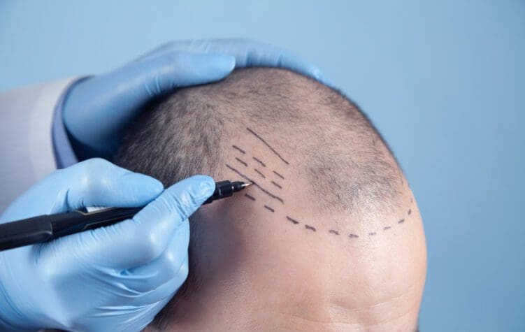 cost of hair transplant surgery