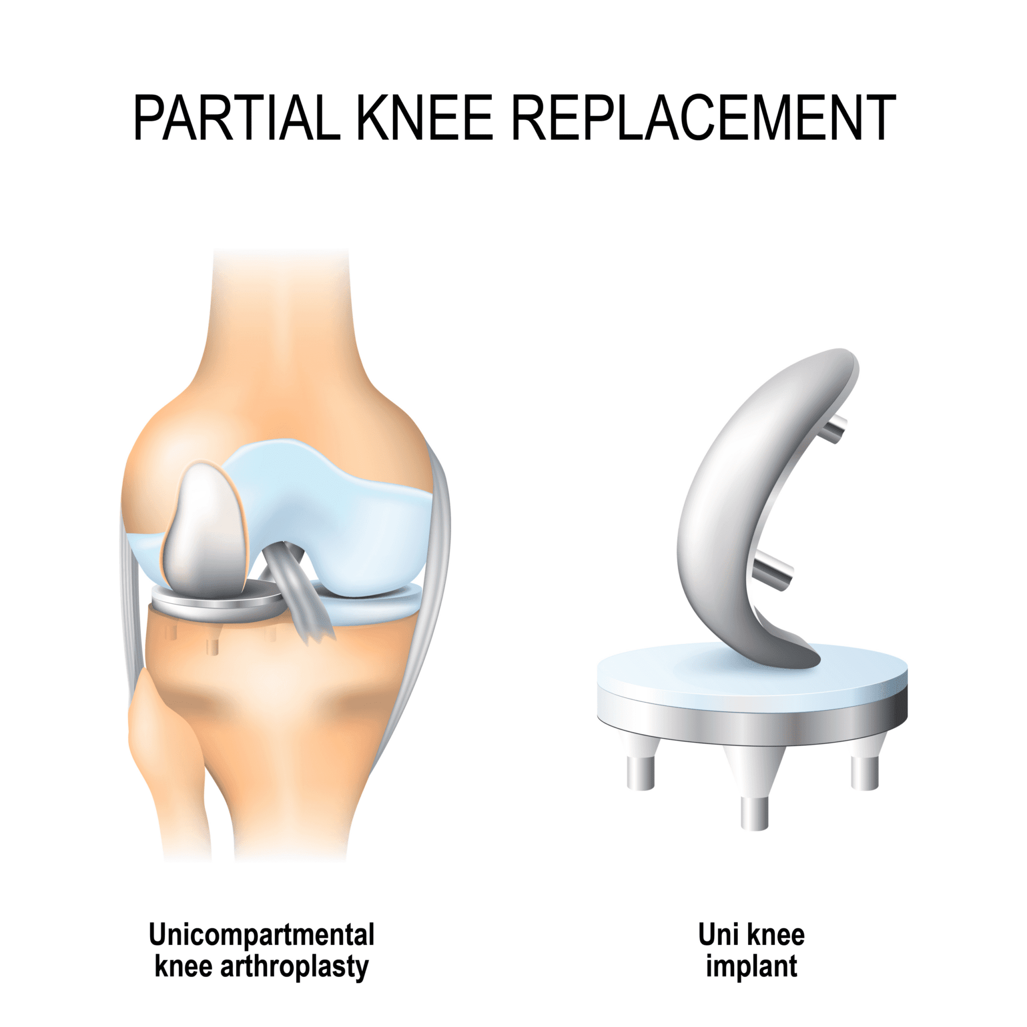 Types of Knee Replacement Surgery In The UK The Best Of Health