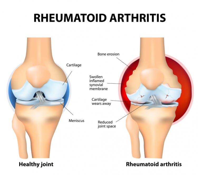 Rheumatoid arthritis diagram