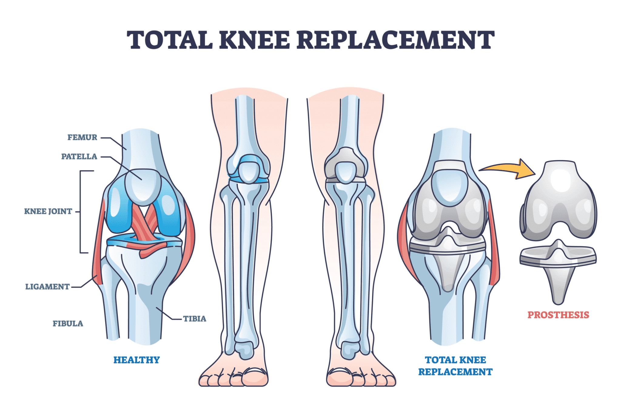 Types of Knee Replacement Surgery In The UK The Best Of Health