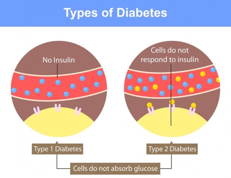 Type 1 & 2 Diabetes difference