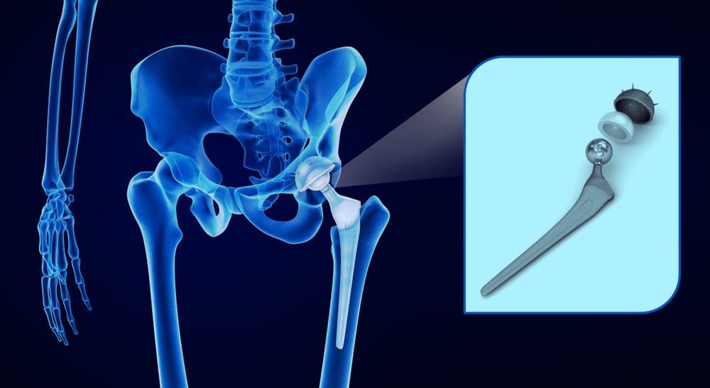 types of hip replacement surgery