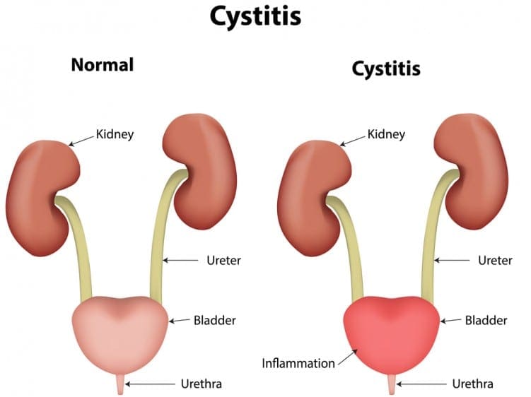 Urinary Tract Infection Cystitis diagram
